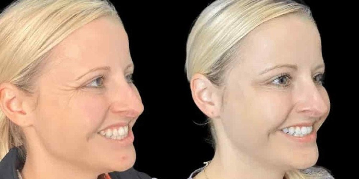 Achieve a Refreshed Look with Botox Treatment in Dubai