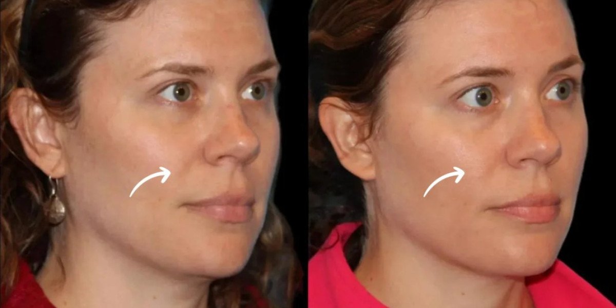 Sculptra in Dubai for Bespoke Beauty Treatment Plans