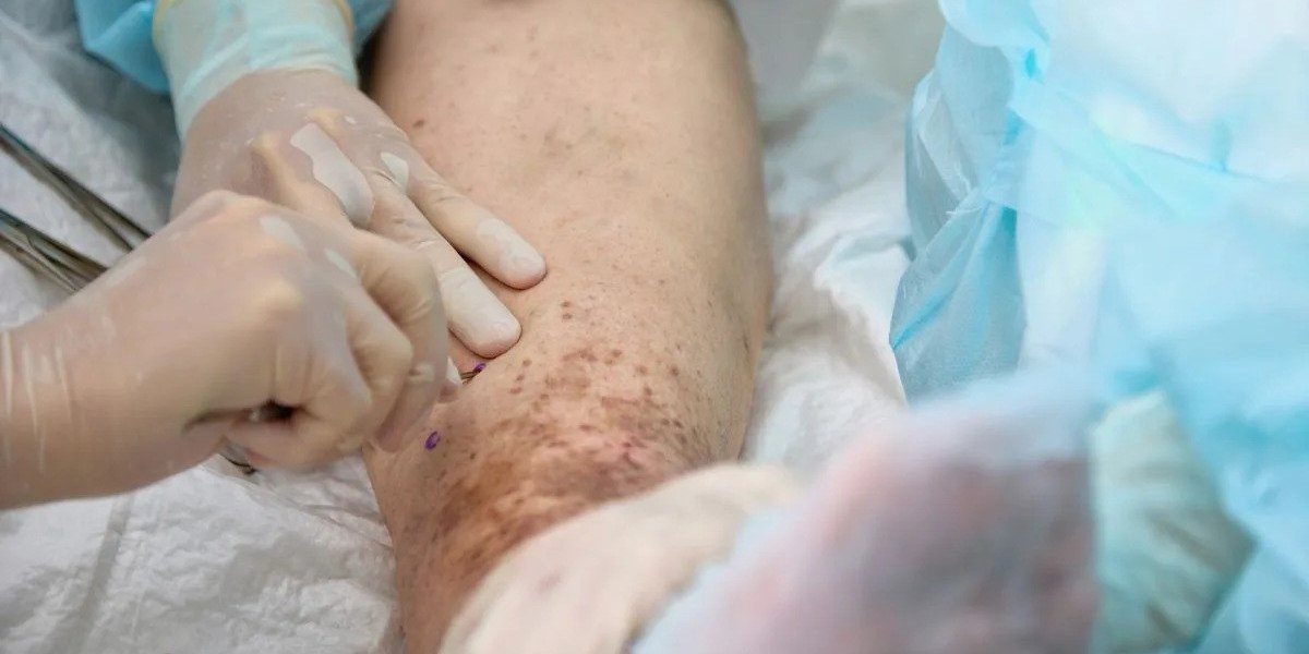 What Is the Best Varicose Vein Treatment for Severe Cases