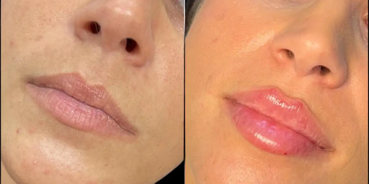 Anti-Aging Dermal Fillers by Best Plastic Surgeon in Dubai