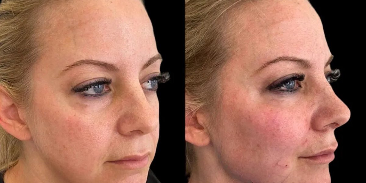How the Best Plastic Surgeon in Dubai Revolutionizing Cheek Fillers Treatments