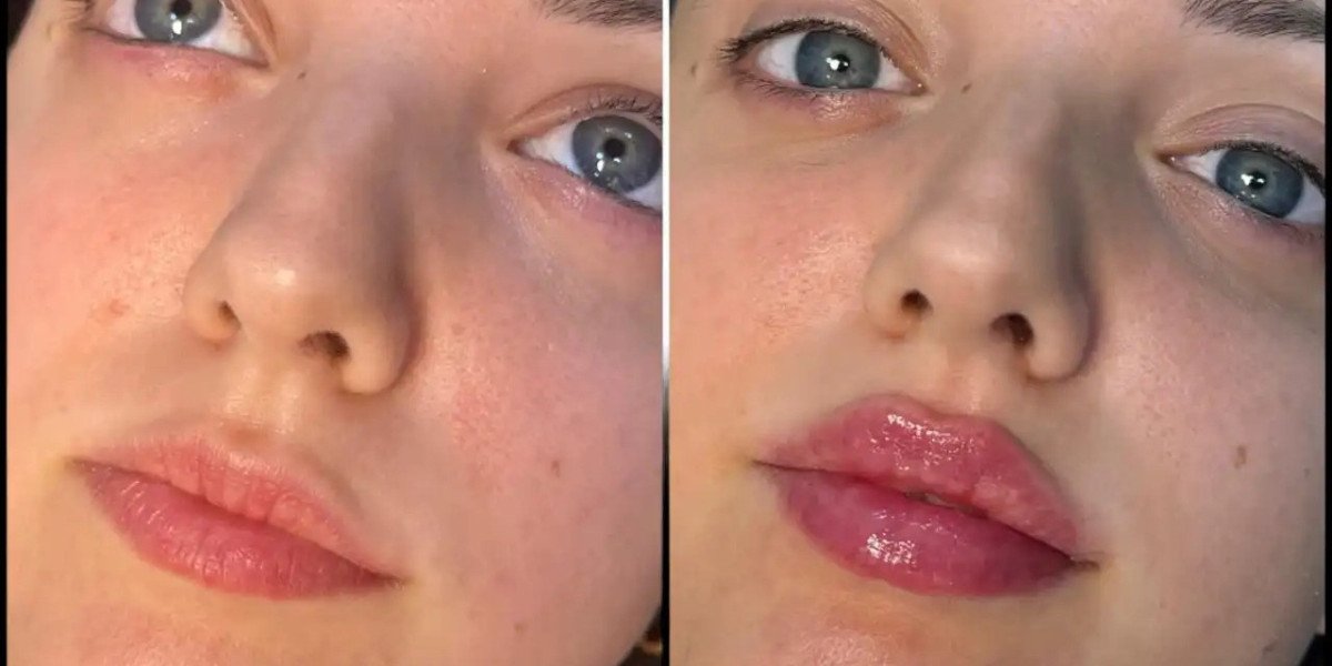 Fillers for Wrinkles by Best Plastic Surgeon in Dubai